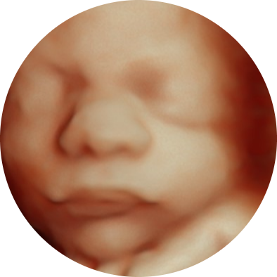 3D Ultrasound