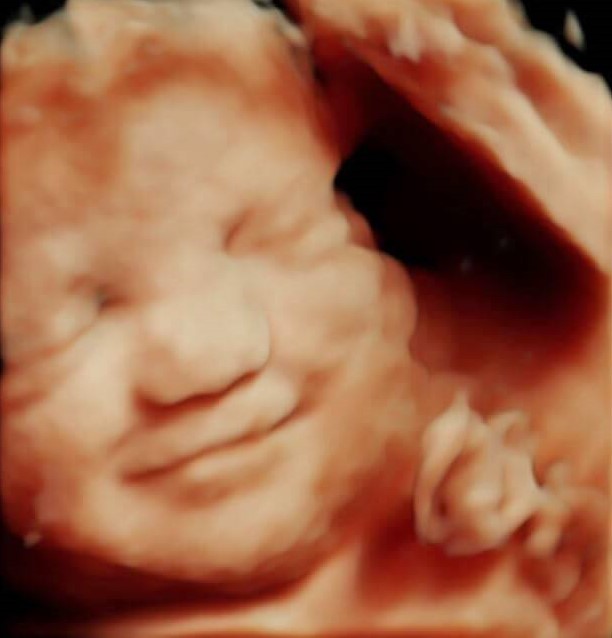 4D Ultrasound