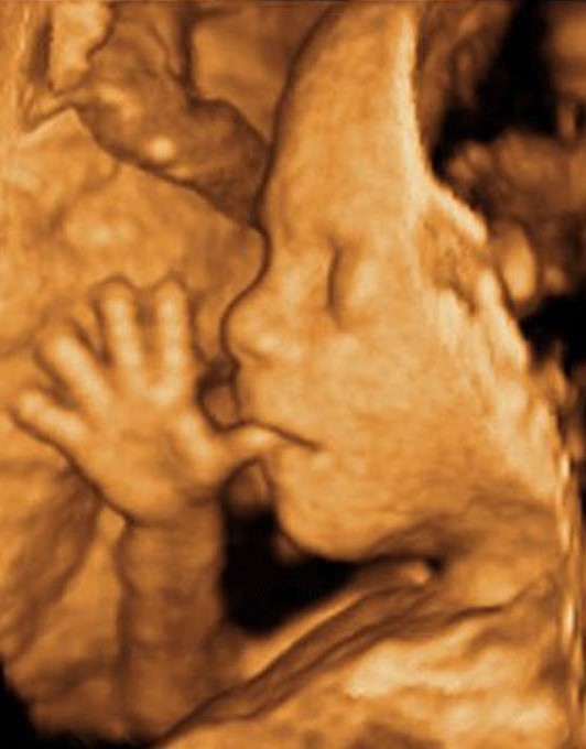 3D ultrasound